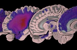USC releases open-source MRI stroke dataset