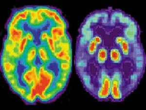 Zuelsdorff & Knopman discuss New research into Alzheimer’s disease and dementia